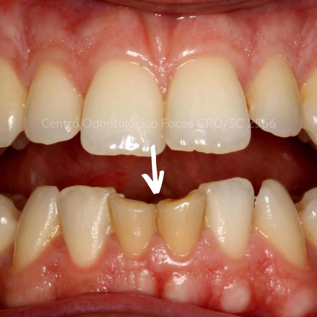 Placa para bruxismo defeituosa pode trazer problemas além dos dentes.