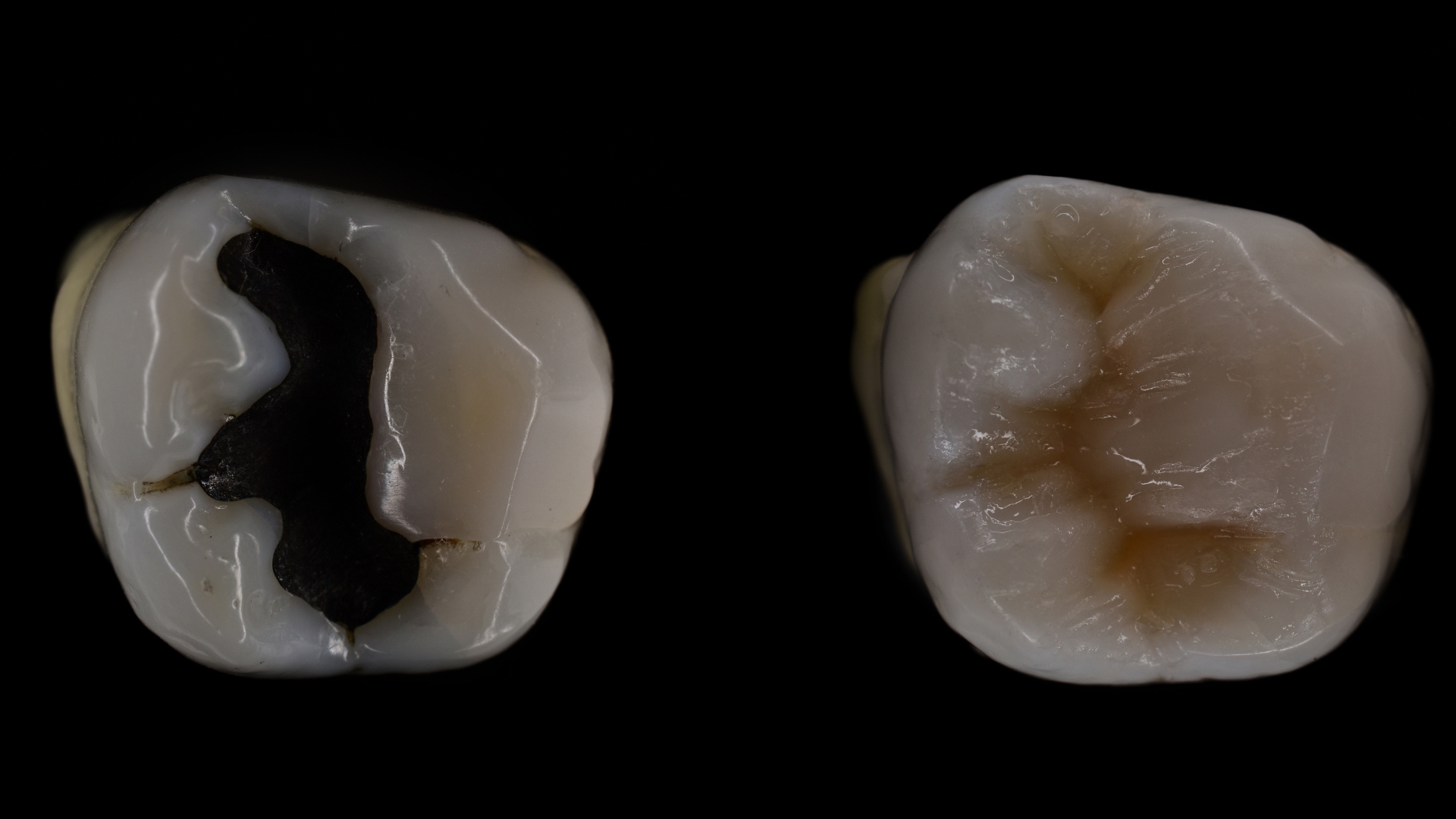 diferença entre a restauração em amálgama e restauração em resina ou porcelana