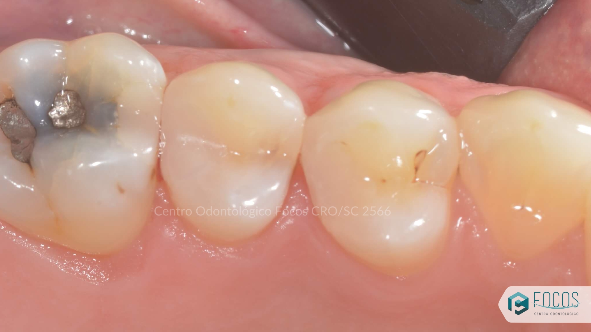 restauração em dentes posteriores depois
